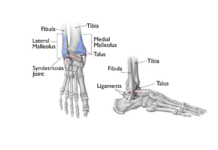Overview Of Bimalleolar Fracture?