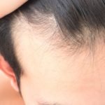 The Main Causes Of Hair Loss In Men And Its Treatment